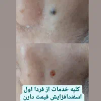 لیزر موهای زائد با روشن کننده جدا