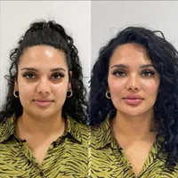تزریق فیلر ژل/بوتاکس/prp پوست مو/پی آر‌پی/مزوتراپی|خدمات آرایشگری و زیبایی|کرج, گوهردشت|دیوار