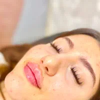 فیلر بوتاکس با ۵۰ درصد تخفیف