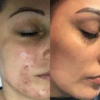 پک ضد جوش و لک نمایندگی اصلی