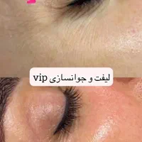 فشیال vip پوست(هفت تیر)|خدمات آرایشگری و زیبایی|مشهد, هفت تیر (حافظ)|دیوار