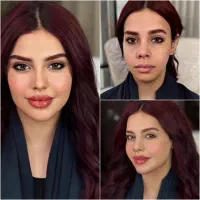 تخفیف ویژه تزریق ژل و بوتاکس(۹۰۰) وپی آر پی ۸۰۰|خدمات زیبایی و سلامت|کرمانشاه, |دیوار