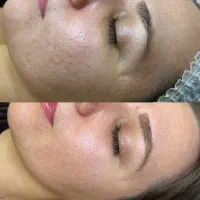 جشنواره روشن کردن صورت و بدن با دستگاه تضمینی