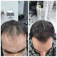 قید کاشت مو رو بزن|آرایشی، بهداشتی، درمانی|تبریز, |دیوار