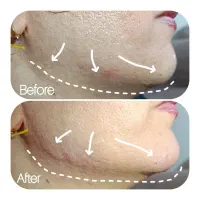 خدمات تزریق ژل و بوتاکس، خال برداری|خدمات آرایشگری و زیبایی|شیراز, حجت آباد|دیوار