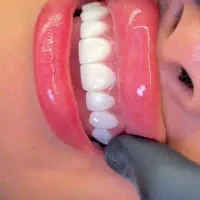 کامپوزیت دندان،زیبایی بدون دردسر