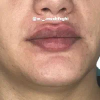 تخفیف ویژه تزریق ژل و بوتاکس