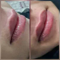 تزریق فیلرصورت
