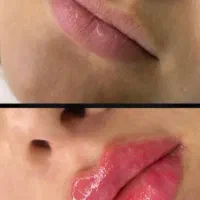 تزریق و آموزش ژل و بوتاکس و مزو وپرسینگ و غیره