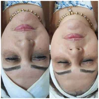 فیشال و پاکسازی پوست تخصصی و درمانی