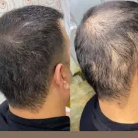 مدل برای میکرواسکالپ سر پر کردن طاسی سر