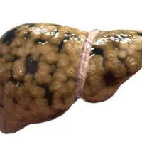 بهبود کبد چرب