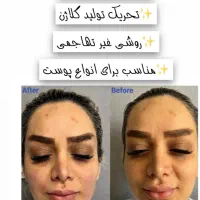فرصت بسیارویژه لیزر ،هایفوتراپی ،ژل بوتاکس ،منظریه|خدمات آرایشگری و زیبایی|فردیس, منظریه|دیوار
