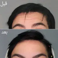 تزریق بوتاکس توسط پزشک ۷۸۰ت|خدمات آرایشگری و زیبایی|شیراز, کوی وحدت|دیوار