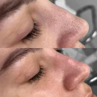 پاکسازی و فشیال پوست