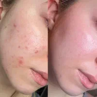 پاکسازی و جوانسازی صورت|خدمات آرایشگری و زیبایی|جم, |دیوار