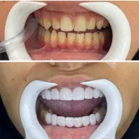 کامپوزیت دندان جشنواره ی تخفیفات تا شب یلدا|خدمات آرایشگری و زیبایی|رشت, معلم|دیوار