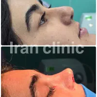 جراحی بینی فقط ۴۳ تومان