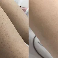 لیزر موهای زائد لیزر مو فشیال پاکسازی پوست|خدمات آرایشگری و زیبایی|تهران, فلسطین (میدان انقلاب)|دیوار