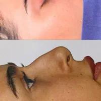آف ویژه عمل زیبایی بینی ۱۹ میلیون|خدمات آرایشگری و زیبایی|شوش, |دیوار
