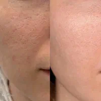 پاکسازی پوست، فیشال و ماسک تخصصی|خدمات آرایشگری و زیبایی|رشت, گلسار|دیوار