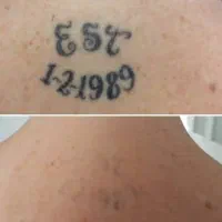 حذف تاتو با لیزر کیوسوئیچ و روشن کننده بیکینی صورت|خدمات آرایشگری و زیبایی|ارومیه, |دیوار