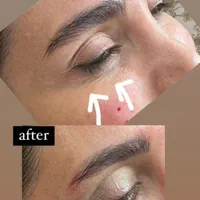 مزو ژل بوتاکس انزیم بینی پلکسرپیرسینگ پاکسازی|خدمات آرایشگری و زیبایی|پرند, فاز ۵|دیوار