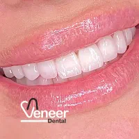 دندانپزشکی ایمپلنت کامپوزیت لمینت ( اقساط بدون سود|خدمات آرایشگری و زیبایی|تهران, الهیه|دیوار