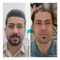 کاشت مو روش سوپر fue