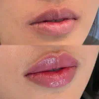 تزریق فیلر،بوتاکس،رفع کک،مک دردوجلسه کلینیک سهند