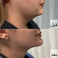 ساکشن غبغب ۳/۵۰۰تومن|خدمات آرایشگری و زیبایی|مشهد, فرهنگ|دیوار