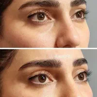 تخفیف ویژه تزریق فیلر|خدمات آرایشگری و زیبایی|اندیشه, اندیشه فاز ۱|دیوار