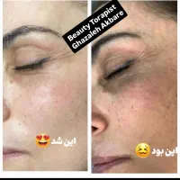 پاکسازی و جوانسازی پوست . هایفو صورت و غبغب|خدمات آرایشگری و زیبایی|مشهد, سجاد شهر|دیوار