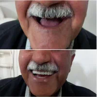 دندان مصنوعی