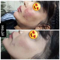 تزریق ژل و بوتاکس ماندگاری بالا مخصوص خانمها