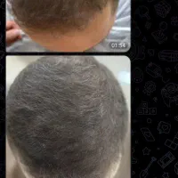 قطع ریزش در دوهفته|آرایشی، بهداشتی، درمانی|خوسف, |دیوار