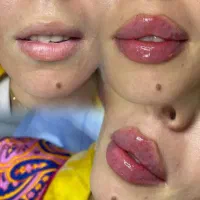 مطب پزشک.ژل وبوتاکس.لیفت بانخ.فیلربینی ژل آلت|خدمات آرایشگری و زیبایی|قم, دورشهر|دیوار