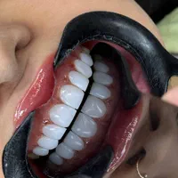 کامپوزیت بدون تراش  باقیمت استثنایی|خدمات آرایشگری و زیبایی|آمل, |دیوار