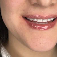 کامپوزیت دندان دندانپزشکی|خدمات آرایشگری و زیبایی|تهران, ستارخان|دیوار