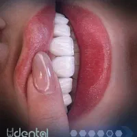 لمینت دندان، پوشش ماندگار لبخند