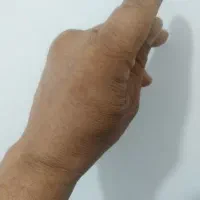 شکسته‌بند‌رگ‌گیری‌حجامت.زردی‌