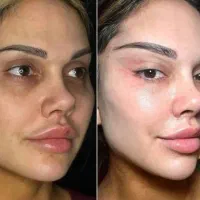لیفت شقیقه ،بلفارو ،غبغب وغیره|خدمات آرایشگری و زیبایی|اهواز, کیانپارس |دیوار