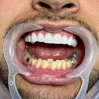 لمینت بدون تراش/کمترین قیمت/بالاترین کیفیت|خدمات آرایشگری و زیبایی|اصفهان, پروین|دیوار