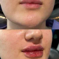 مطب تزریق ژل لب تخفیف فیلر لیفت صورت بوتاکس