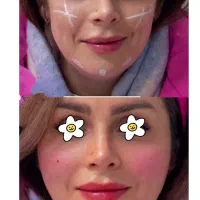 بوتاکس رایگان فقط با انجام ۲ سی سی فیلر