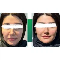 بوتاکس،فیلر،مادلینگ صورت،انواع جوانساز|خدمات آرایشگری و زیبایی|کرمانشاه, |دیوار