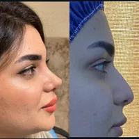 جشنواره عمل بینی فقط ۳۰ میلیون تومن با شرایط چکی