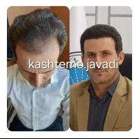 کاشت مو و ابروی طبیعی