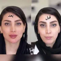 جشنواره تخفیف فیلر و بوتاکس