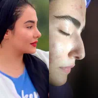 جراحی بینی فقط ۵۰ میلیون